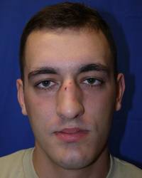 Before rhinoplasty