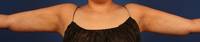 Arm Liposuction after 
