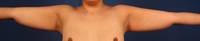 Arm Liposuction Before