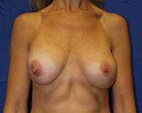 Breast Augmentation Before