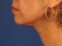 Neck Liposuction after