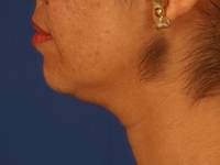 Neck Liposuction Before