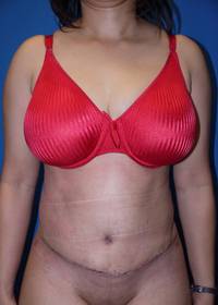 Abdominoplasty after