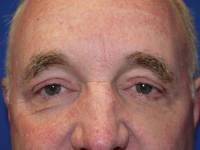 Eyelid Surgery After
