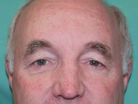 Eyelid Surgery Before