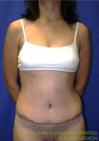 Tummy Tuck AFter