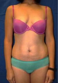 Tummy Tuck Before