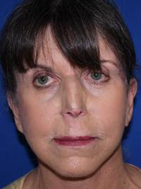 Facelift after