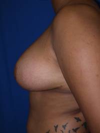 After breast reduction - Left Side