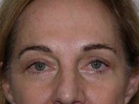 Blepharoplasty after