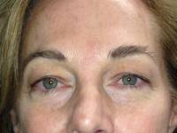 Blepharoplasty before