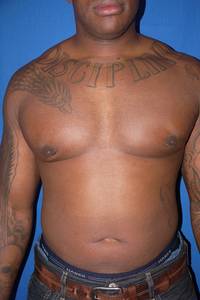 Gynecomastia After