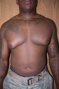 Gynecomastia Before