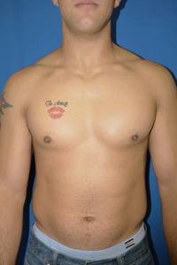 After Gynecomastia
