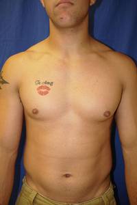 Before Gynecomastia