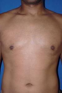 Gynecomastia After