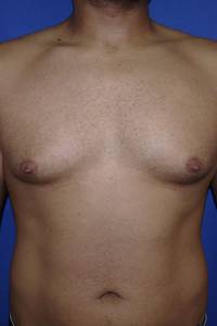 Gynecomastia Before