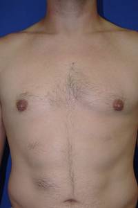 Gynecomastia After