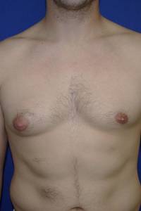 Gynecomastia Before