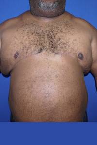 Male Liposuction After