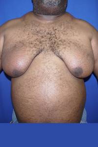 Male Liposuction Before