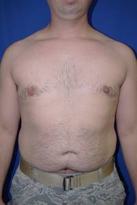 Gynecomastia After