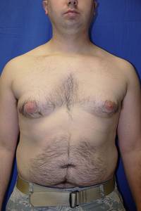 Gynecomastia Before