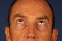 Eyelid Surgery Before