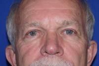Eyelid Surgery after