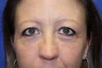 Eyelid Surgery Before