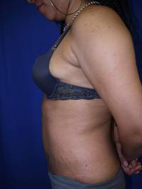 Tummy Tuck After