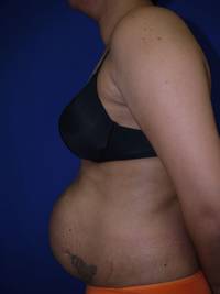 Tummy Tuck Before