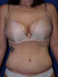 Tummy Tuck After