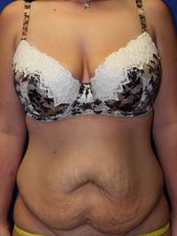 Tummy Tuck Before
