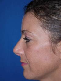 Rhinoplasty after