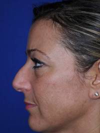 Rhinoplasty Before