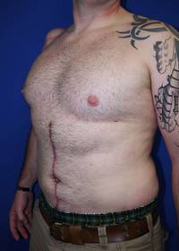 Liposuction after