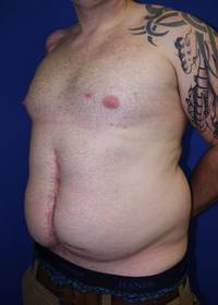 Liposuction Before