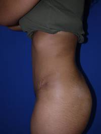 Tummy Tuck after 