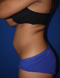 Tummy Tuck Before 