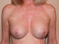 Breast Revision After
