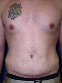 After Tummy Tuck After Weight Loss Surgery