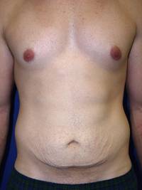 Before Tummy Tuck After Weight Loss Surgery