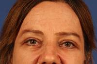 Eyelid Surgery After