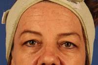Eyelid Surgery Before