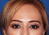 Lower Blepharoplasty After