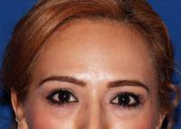 Lower Blepharoplasty Before
