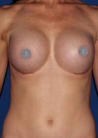 Breast Augmentation after