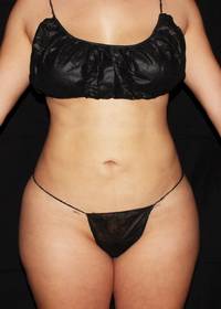 Full Torso Liposuction After
