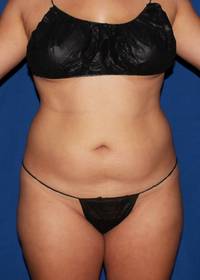Full Torso Liposuction Before